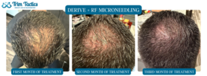 Trim Tactics Reports Positive Patient Outcomes with Combined Derive Hair Regeneration and Scarlet Pro RF Microneedling